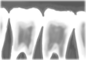Braces (orthodontics)